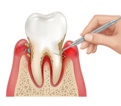 Gum Treatment