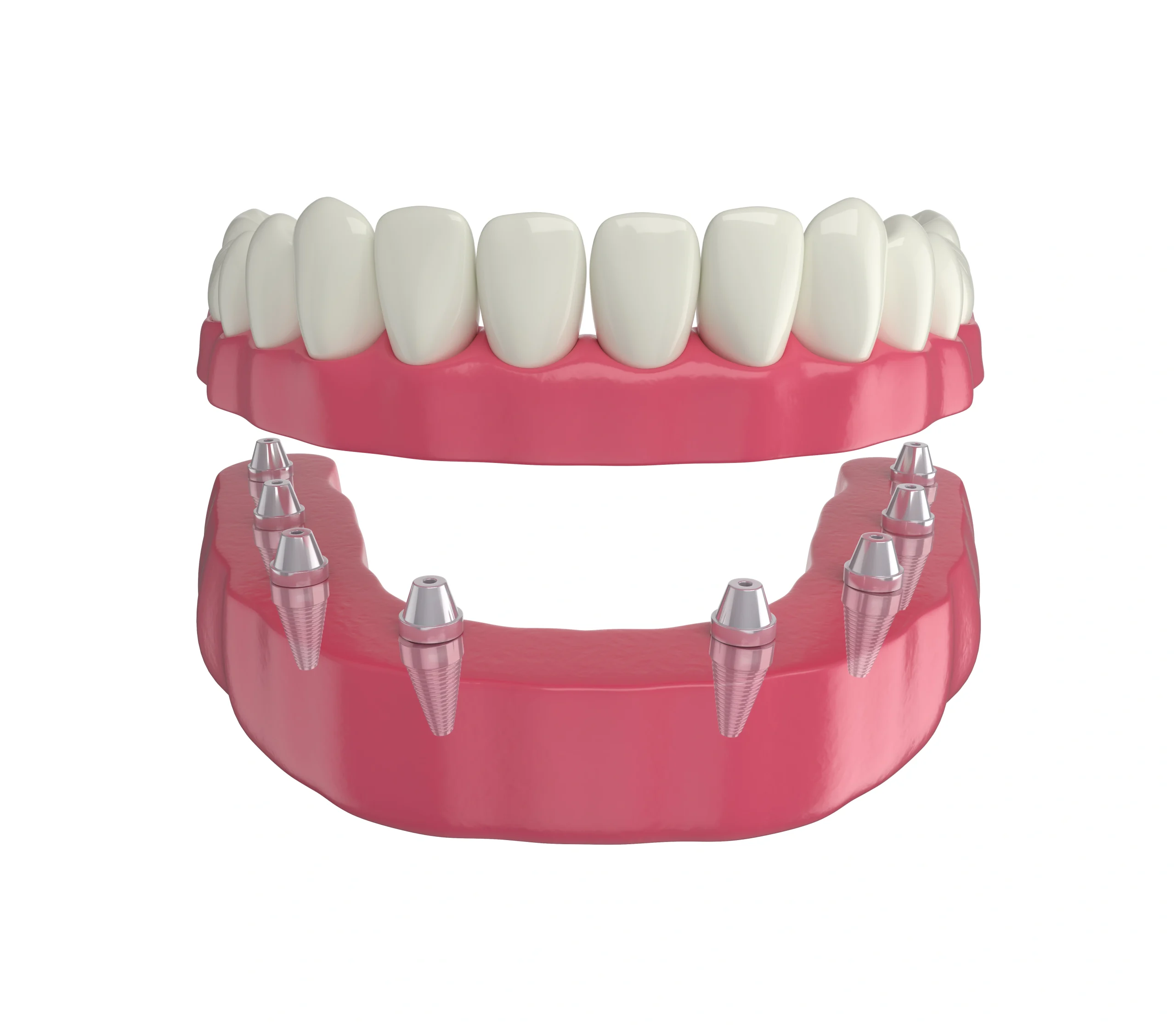 Implant-Supported Dentures